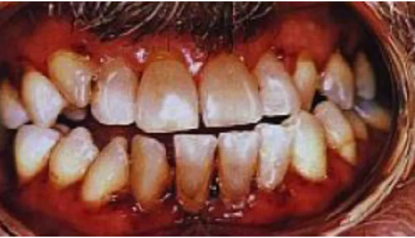 Figure 14 : pétéchies de la muqueuse orale (disponible sur www.dentalcare.cafr) 