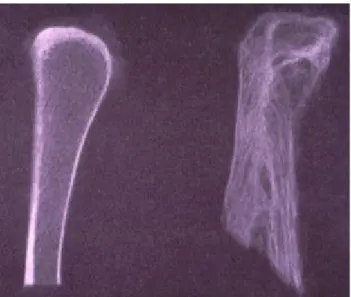 Figure 6: Comparaison entre une trame osseuse   normale (à gauche) et la trame osseuse d'un os  