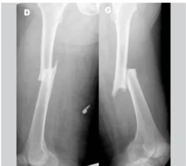 Figure 12: Fracture des fémurs droit et gauche   d'une patiente de 72 ans. (source: travaux du Dr  