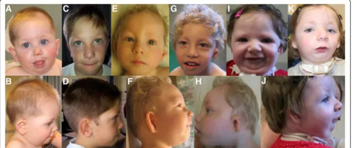 Figure 5 Craniofacial phenotype of three patients with de novo EFTUD2 mutations. (A, B) Patient 6 at the age of 12 months with round face, mildly downslanting palpebral fissures, micrognathia and mild hypoplasia of the upper ear and squared earlobes