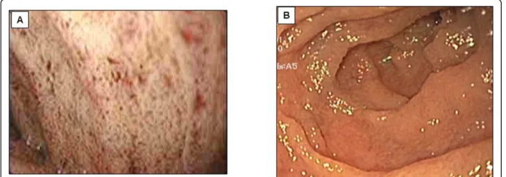 Figure 2 Endoscopy of a CRD patient. Upper endoscopy reveals a white duodenal mucosa in CRD (Panel A) compared with normal subjects (Panel B).