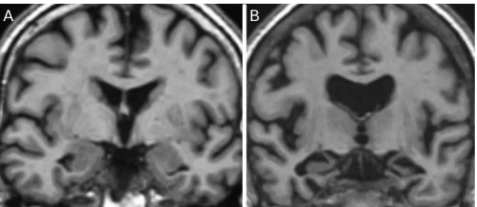 Figure 1.1: High resolution T1 MRIs of A ) an healthy elder (005_S_0602) and B ) an AD subjects (005_S_0221) of the ADNI database.