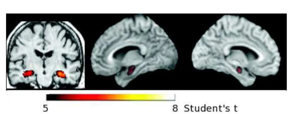 Figure 1.3: Voxel based morphometry. Areas of statistically signicant grey matter loss in AD patients as compared to a reference healthy group (from [Frisoni et al., 2009])