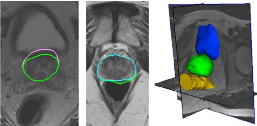 Figure 11 : Comparaison entre la surface de la prostate : à gauche, au niveau de la vessie par OSD  simple (mauve) et OSD multi-objets (vert) ; au milieu au niveau du rectum par OSD simple (vert) 