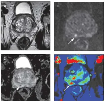 Fig 1.2: A 65-year-old male with prostate-specific antigen (PSA)  level of 5.1 ng/ml and prior negative transrectal ultrasound  (TRUS)-guided biopsy was referred for multi-parametric prostate 