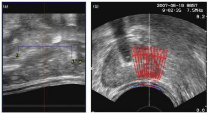 Fig 2.4 Planning (a) Annotation of the base (U), the apex (A)  and a margin of safety (L) on the transverse slice, (b) Definition of  the rectal wall and a variety of lesions in the left lobe on an axial 