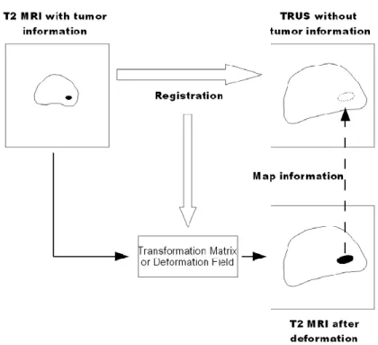 Fig 2.7 TRUS-MR registration. The information of tumor position  can be mapped from MRI to TRUS image