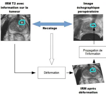 Figure 4 : Cadre général de l’étude. Fusion IRM T2 vers image échographique. 