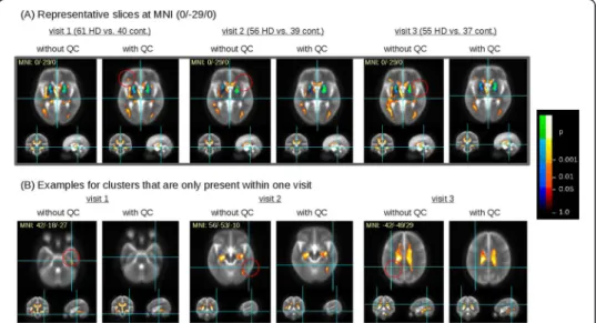 Figure 5 Results of cross-sectional group comparison. Clusters of significant FA differences between HD subjects and controls for the three visits