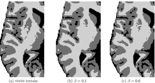 Fig. 4.17: Influence du coefficient β sur les résultats de segmentation du volume (n = 7%, rf = 20%)