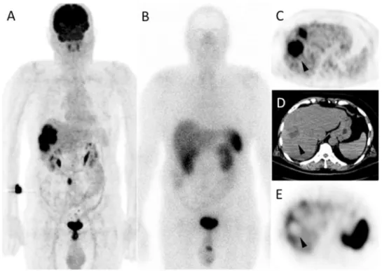 Figure 3 Results of FDG PET (A,C), SRS-SPECT (B,E) and corresponding non-enhanced CT slice (D) performed in a 63-year-old patient with poorly differentiated rectal NET (Ki-67, 11%)