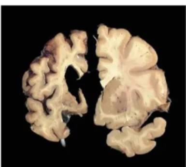 Figure 2: The HD brain degenerates. Images showing a normal human brain slice on the right and an advanced  stage 4 HD brain slice on the left