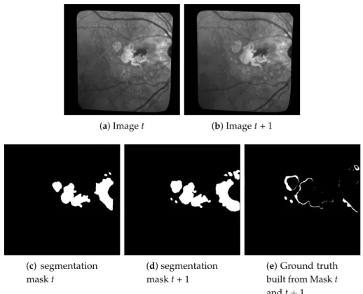 Figure 12. Example of ground-truth build for patient 010 based on two consecutive masks of segmented lesions at time t and t + 1: All changes inside the lesions, textural or otherwise, are ignored.