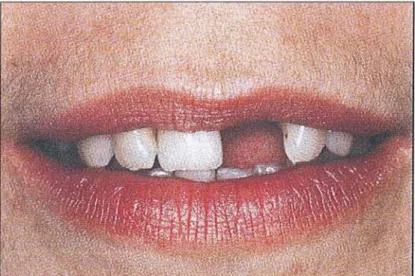 Figure 2 : Ligne de sourire basse (Paris J. C., Faucher A. J., 2003)
