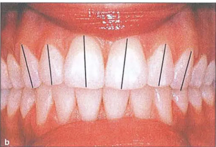 Fig ure 8 : Inclinaison axiale dan s le se cteur antérieur (Sclar A. G., 2005)