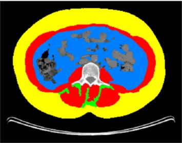 Fig. 1 Axial CT image of the third lumbar vertebral region with corresponding highlighted body composition in patients: skeletal muscle mass (SMM) in red, visceral (VAT) in blue, subcutaneous (SAT) fat tissues in yellow, and muscle fat infiltration (IMAT) 