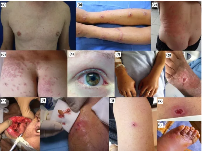 Figure 1 (a – l) Clinical presentations of several imported dermatoses in a cohort of returning travellers, Bordeaux, 2015 – 2018, top to bot- bot-tom, left to right: (a) papular rash after Zika virus infection acquired in Nicaragua; (b) ecthyma of the low
