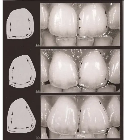 Figure I.4 : Les 3 types de formes :  1.  Dans le type de dents carré, les 