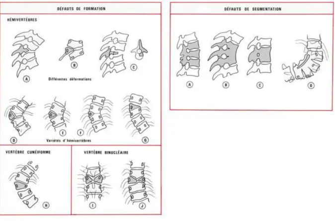 Figure 3 Les différents types de déformations vertébrales [18]. 