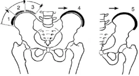 Figure 15 Test de Risser [27, 28]. Il est basé sur la progression de l’ossification de la  crête iliaque
