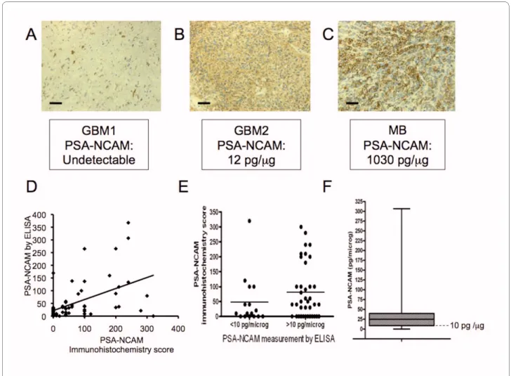 Figure 2 PSA-NCAM measurements by immunohistochemistry and ELISA, and distribution of PSA-NCAM measurement by ELISA in 56 GBM  biopsies
