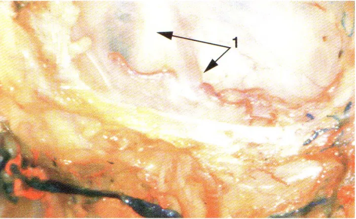 Figure 18. - Le toit du sinus maxillaire correspond au plancher de l’orbite. 1: nerf et artère infra- infra-orbitaire