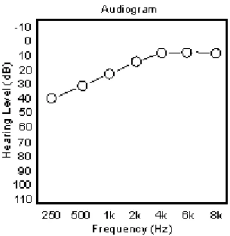 Figure 5 : Exemple d’audiogramme  de perte  auditive en pente inversée de classe 1 [11] 