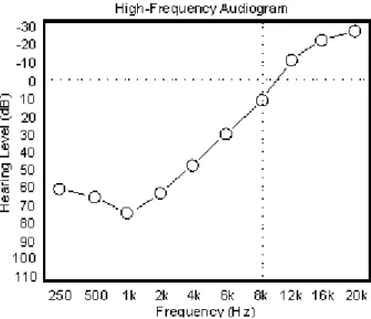 Figure 7 : Exemple d'audiogramme  de perte auditive  en pente inversée de classe 3 [11] 