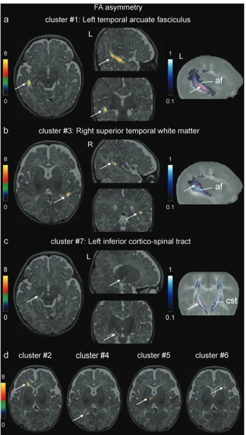 Figure 2. Whole brain voxel-based analysis of FA asymmetry (Analysis A). Asymmetrical regions with higher FA (Table 2) are shown at the level of the left temporal arcuate fasciculus (a), right superior temporal white matter (b), left inferior cortico-spina