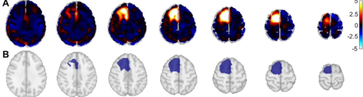 Fig 1. Generation of the mask for each tumor. A. Z-score map obtained from SPM12 between each patient and a population- population-averaged normal 18 F-FET PET brain template