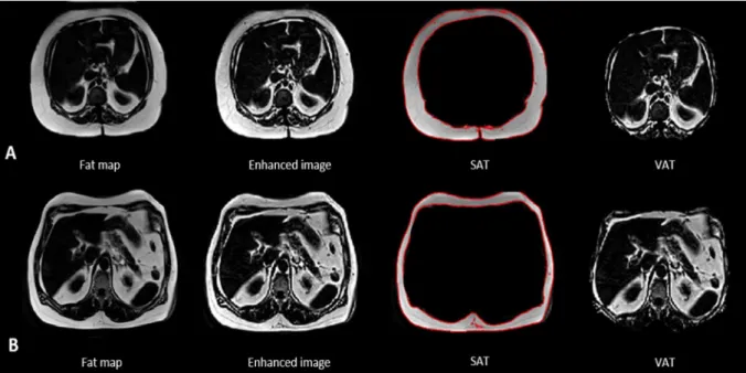 Fig. 5. Fat maps segmentation for a female patient with MS (A) with BMI  = 33 kg/m 2 , SAT  = 31% (102 g) and VAT  = 50% (56 g) and a female patient with T2DM  (B) with BMI  = 33 kg/m 2 , SAT  = 19.5% (84 g) and VAT  = 60.3% (123 g)