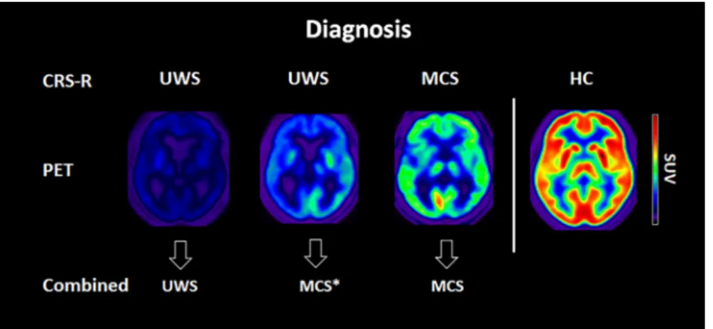 FIGURE 2: Examples of representative SUV for VS/UWS, MCS * and MCS patients and HC. Red colour represents a high brain metabolism (max SUV = 12), while blue represents low metabolism