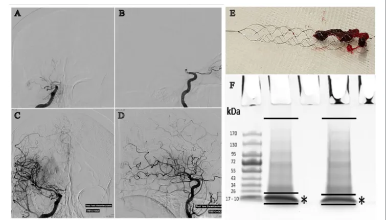 FIGURE 1 | Cerebral angiography showing a right MCA occlusion before (A: anteroposterior projection, B: lateral projection) and after recanalization (C: