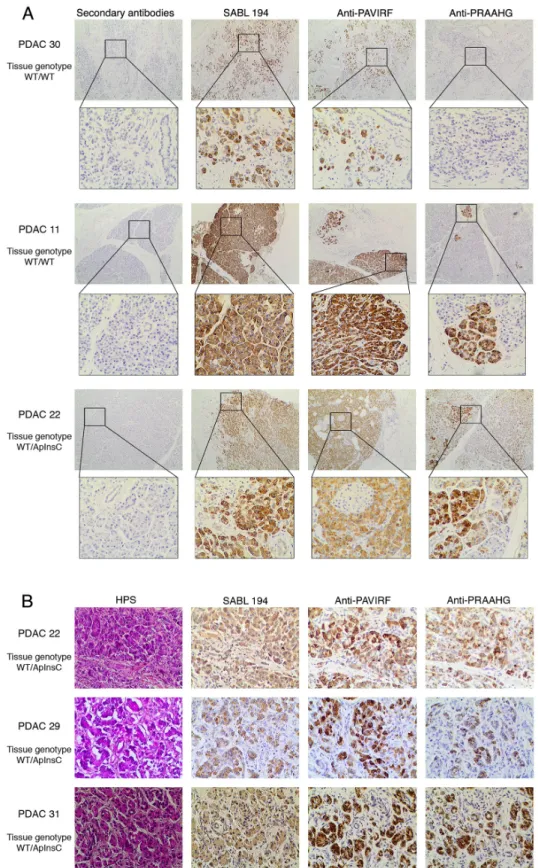 Figure  6:  Immunohistochemistry  on  human  pancreatic  tumors. A.  Formalin-fixed,  paraffin-embedded  tissue  sections  of  pancreatic tissue from genotyped WT/WT or WT/ApInsC tissue patients (PDAC 11, 22 and 30 refer to Supplementary Table S1) were  st