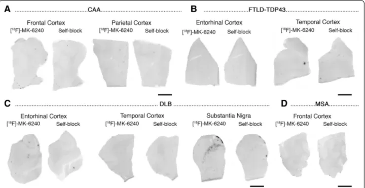 Fig. 2 [F-18]-MK-6240 phosphor screen images of brain slices from a CAA carrier of the D23N Iowa APP mutation (#17) (a), FTLD TDP-43 (#40,
