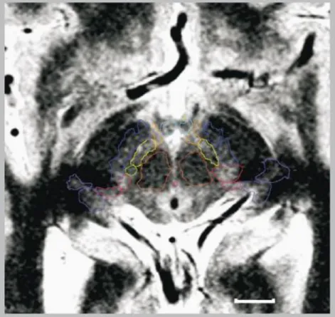 Figure  3.  Axial  1.5-T  MRI  slices.  Imaging  (deep  brain  stimulation  surgery,  Parkinsonian)  on  a  Sonata  machine  (Siemens,  GmbH,  Erlangen,  Germany),  inversion-recovery  sequence,  stereotactic  conditions;  voxel  size=0.52×0.62×2  mm3