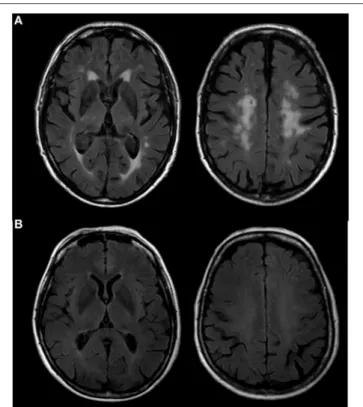 FIGURE 1 | FLAIR scans of older subjects presenting a high (A) and a low (B) level of WMH according to the Fazekas scale.