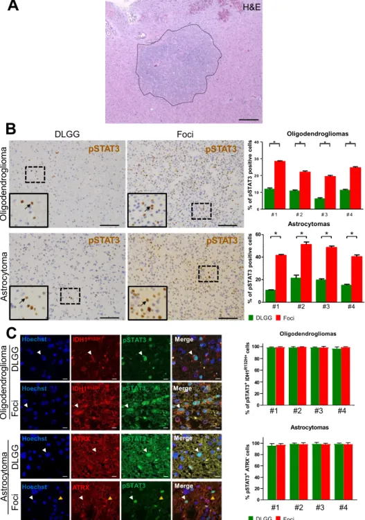 Figure 1.  pSTAT3 stainings in diffuse low-grade glioma foci. (A) Example of a high cell density foci detected  in a diffuse low-grade glioma