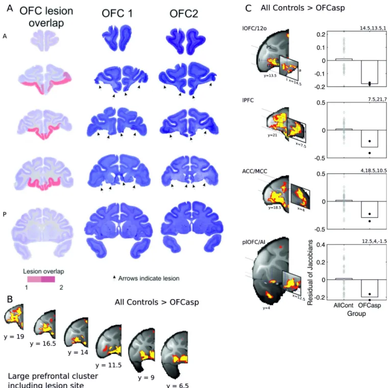 Fig 4. Lesions of central and medial OFC and adjacent vmPFC between the lateral orbital sulcus and the rostral sulcus