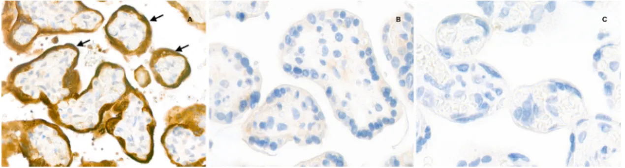 Fig. 5 Placental immunostaining for SARS-CoV-2 N-protein (anti-N immunohistochemistry, original magni ﬁ cation ×800)