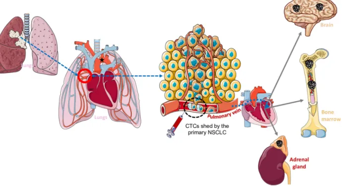 Fig. 3. NSCLC-derived CTC detection in the pulmonary vein. NSCLC metastatic sites are primarily bone marrow, brain, and adrenal gland.