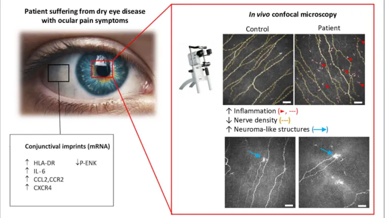 FIGURE 5 | Morphological and molecular changes in the ocular surface from dry eye patients with persistent ocular pain