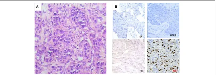 FIGURE 1 | Histological patterns at diagnosis of a 32-year-old patient with triple negativity that reached a complete pathological response after PO treatment