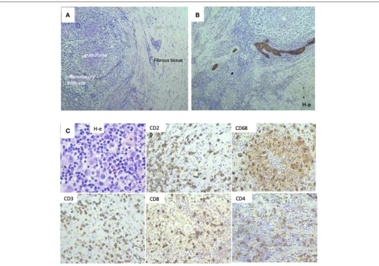 FIGURE 2 | Histological patterns after Polyoxidonium (PO) administration of a 32-year-old patient with triple negativity that reached a complete pathological response after treatment
