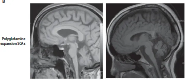 Figure 2.2 – Atteinte du cervelet chez des patients SCA2 (` a droite) et SCA3 (` a gauche)[Durr, 2010] : coupe sagittale de l’Imagerie ` a Raisonnance Magn´ etique (IRM) montrant l’implication du tronc c´ er´ ebral avec une atteinte relativement mineure du