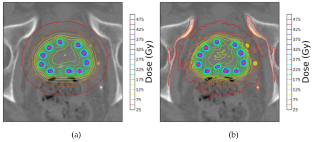 Figure 13 – Image TDM du pelvis d’un patient avec en surimpression les isodoses provenant (a) du formalisme TG 43 et (b) de la SMC avec GGEMS.
