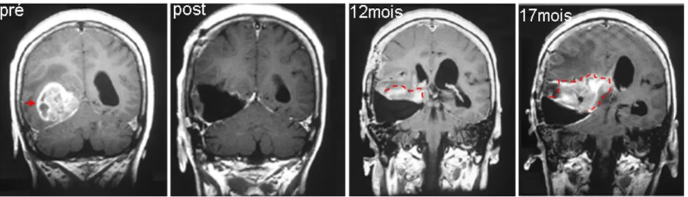 Figure 8 : Récurrence d’un glioblastome après résection totale de la tumeur .  