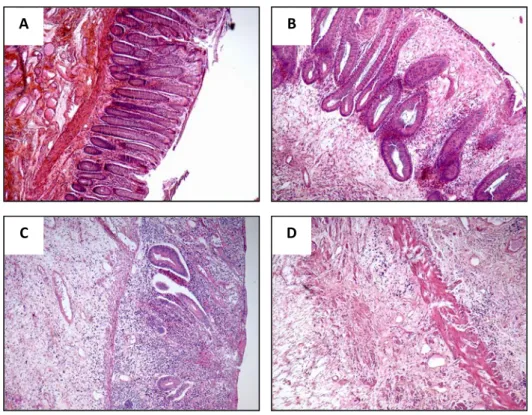 Figure 5 : Histopathologie de la rectite radique chez l’Homme. Résections chirurgicales 5 à 7 semaines après  radiothérapie préopératoire pour adénocarcinome rectal, dose totale de 45 Gy