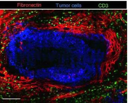 Figure 9 : Distribution de cellules T relative aux fibres de fibronectine et aux cellules tumorales dans une tumeur de poumon  humain