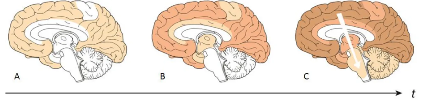 Figure 6: Distribution des dépôts amyloïdes dans le cerveau aux différents stades de la maladie